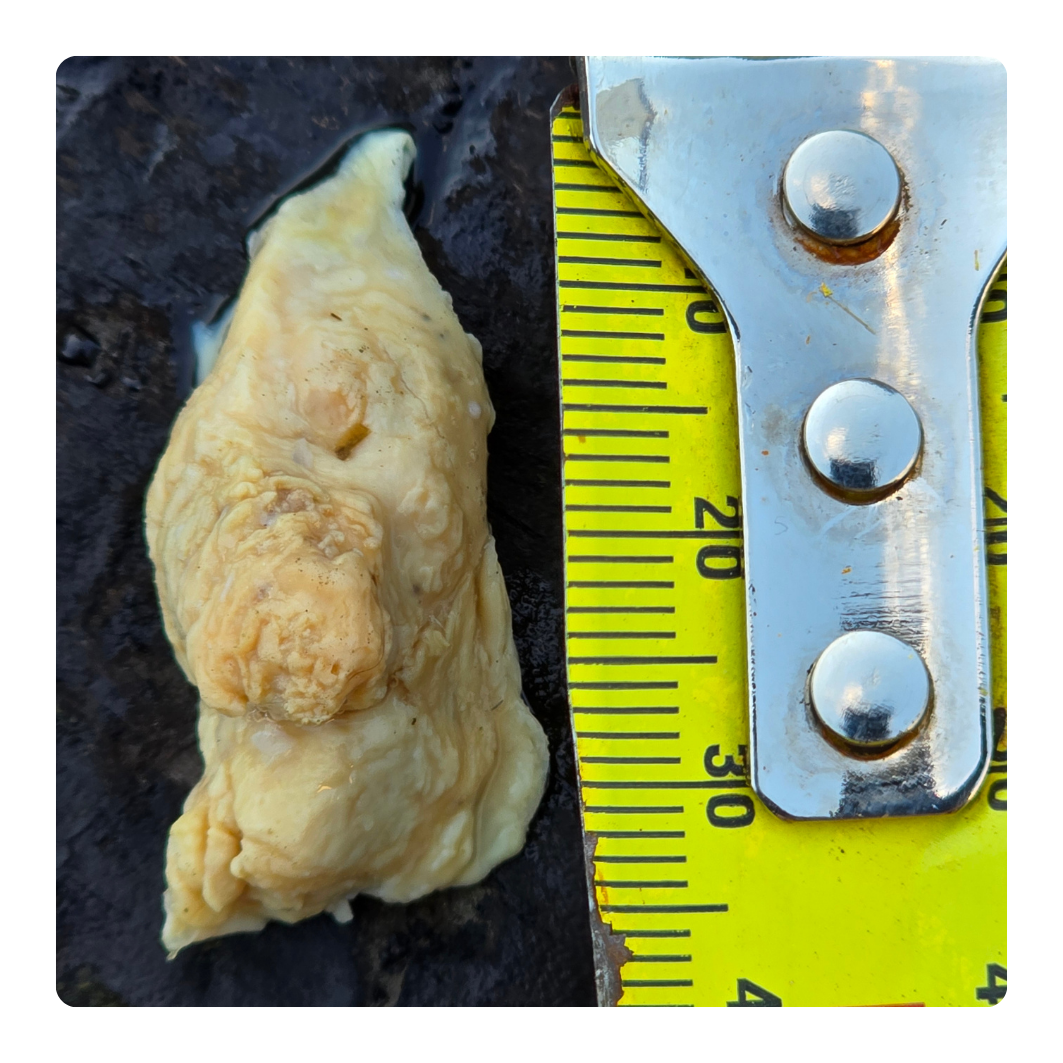 canker lesion once dislodged from throat with measuring tape for size